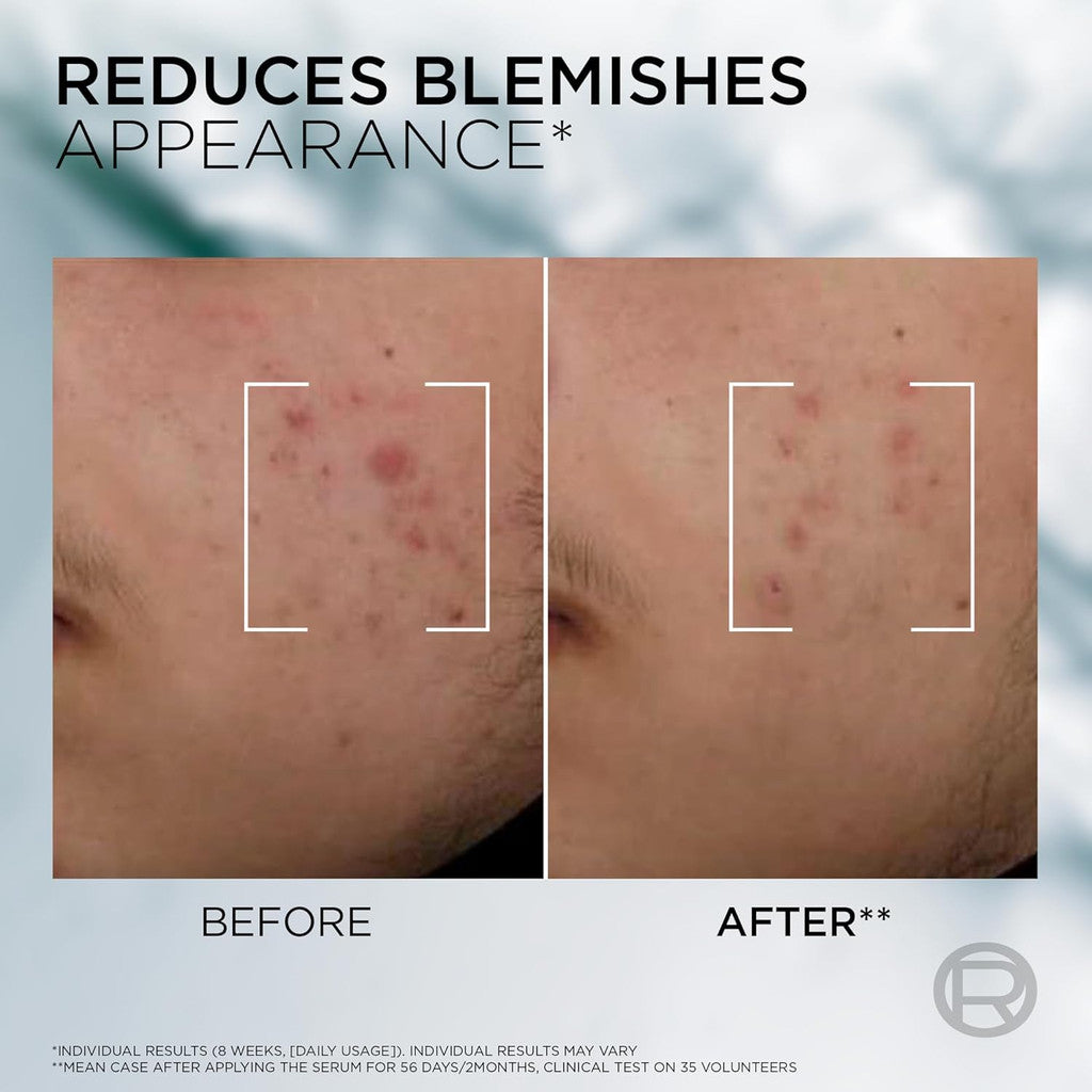 L'Oreal Men Expert Derma Control Anti-Blemish Serum - 30ml - Certified from L'Oreal